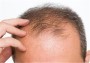 شیوه جدید درمان ریزش مو